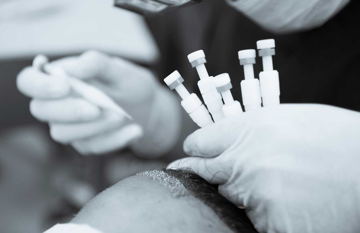 Hair Transplant, HAIR TRANSPLANT