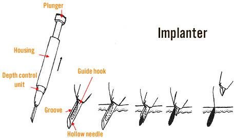 Hair Transplant, HAIR TRANSPLANT