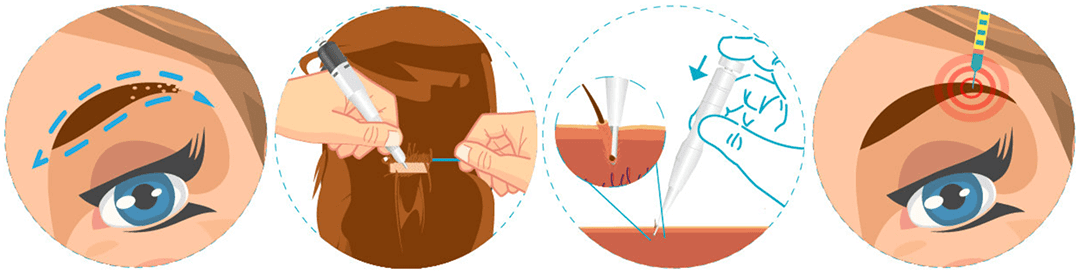 , EYEBROW TRANSPLANT