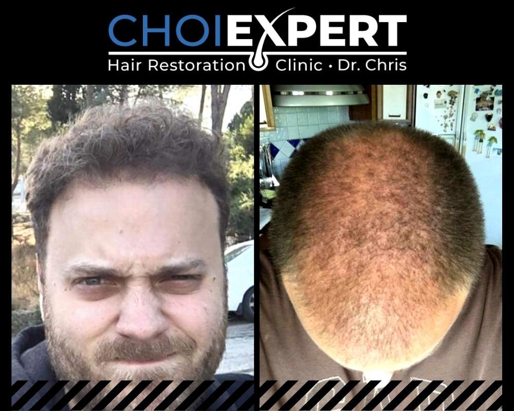 , VORHER NACHHER ERGEBNISSE