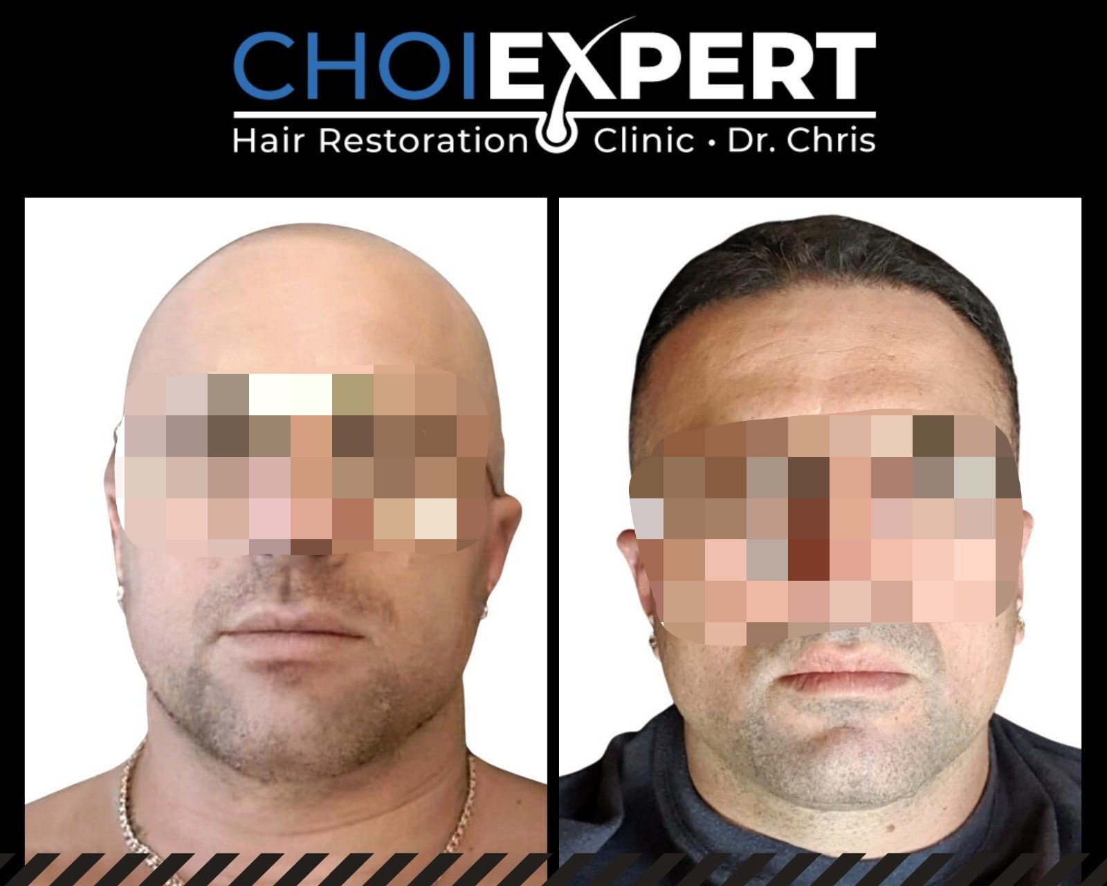 , VORHER NACHHER ERGEBNISSE