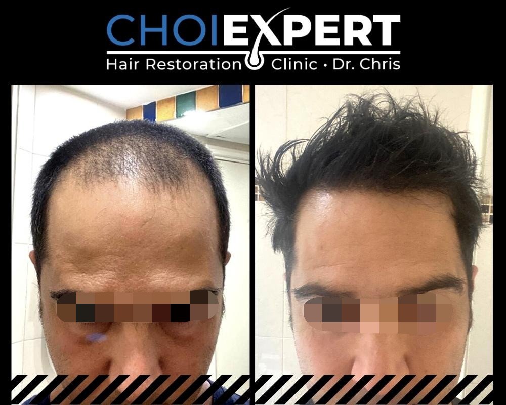 , VORHER NACHHER ERGEBNISSE