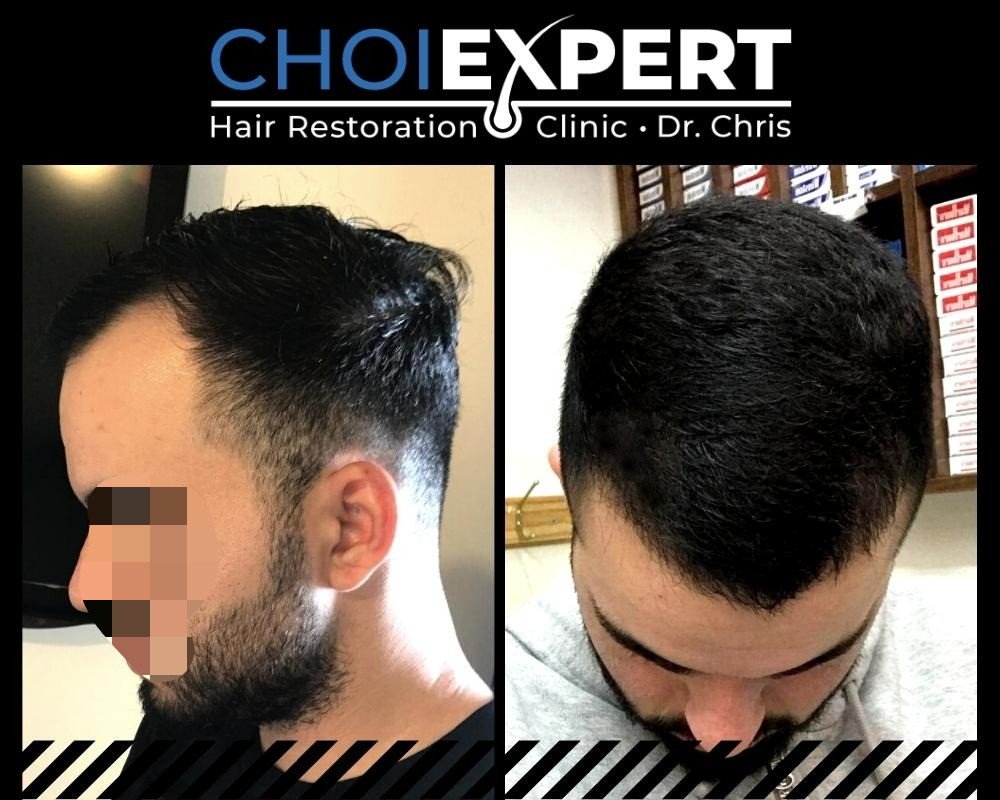 , VORHER NACHHER ERGEBNISSE