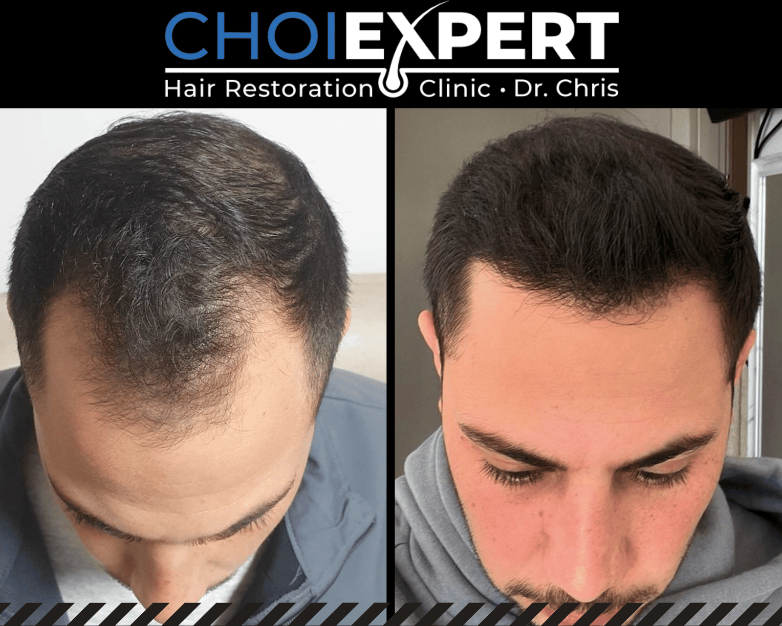 , VORHER NACHHER ERGEBNISSE