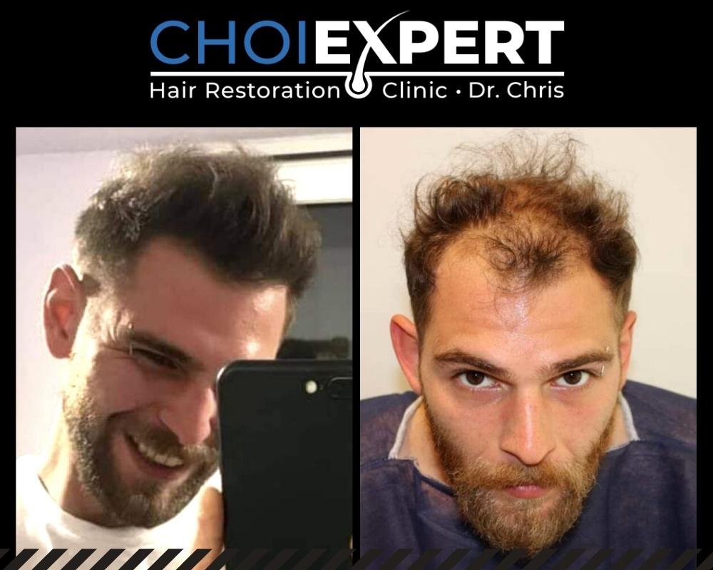 , VORHER NACHHER ERGEBNISSE