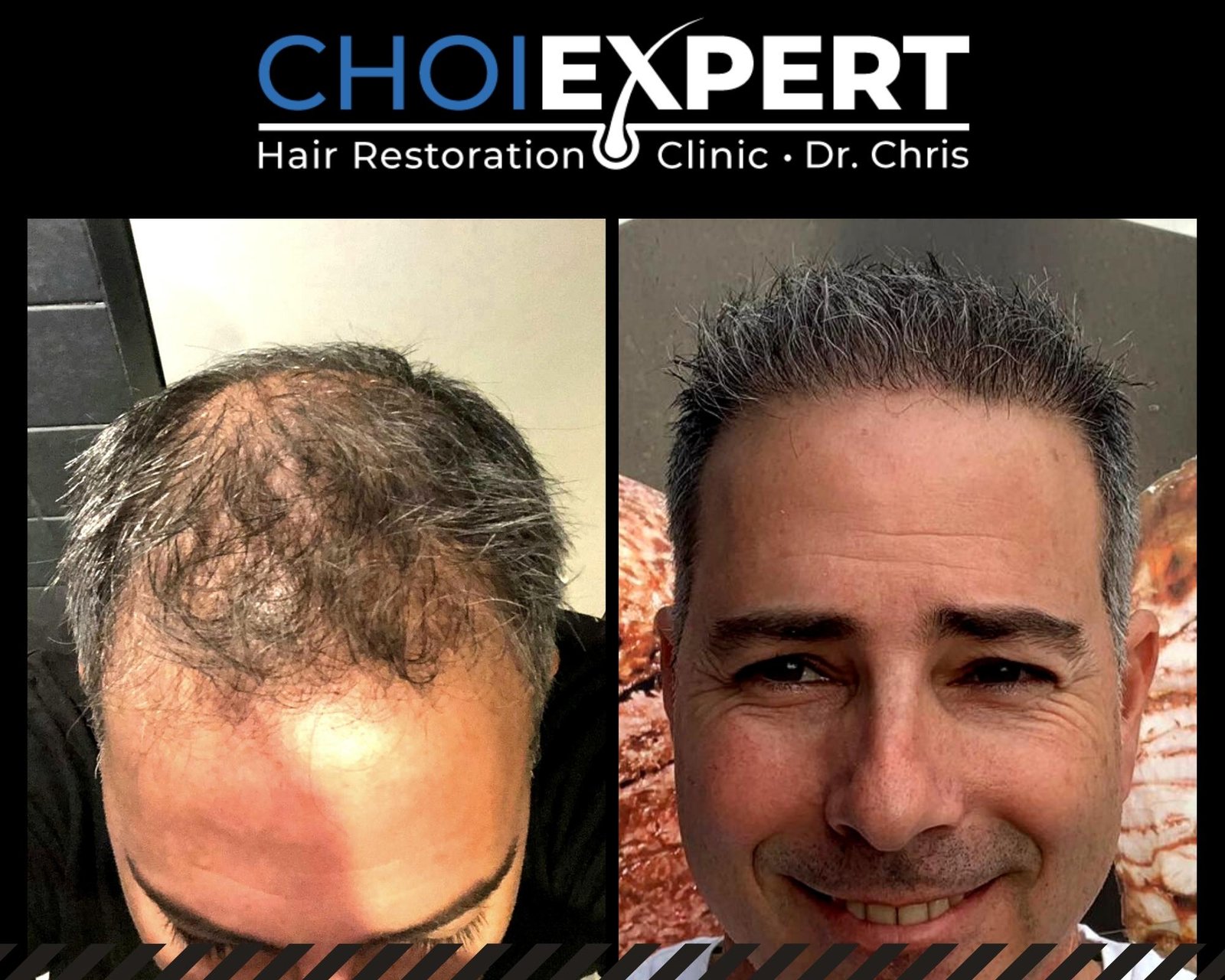 , VORHER NACHHER ERGEBNISSE