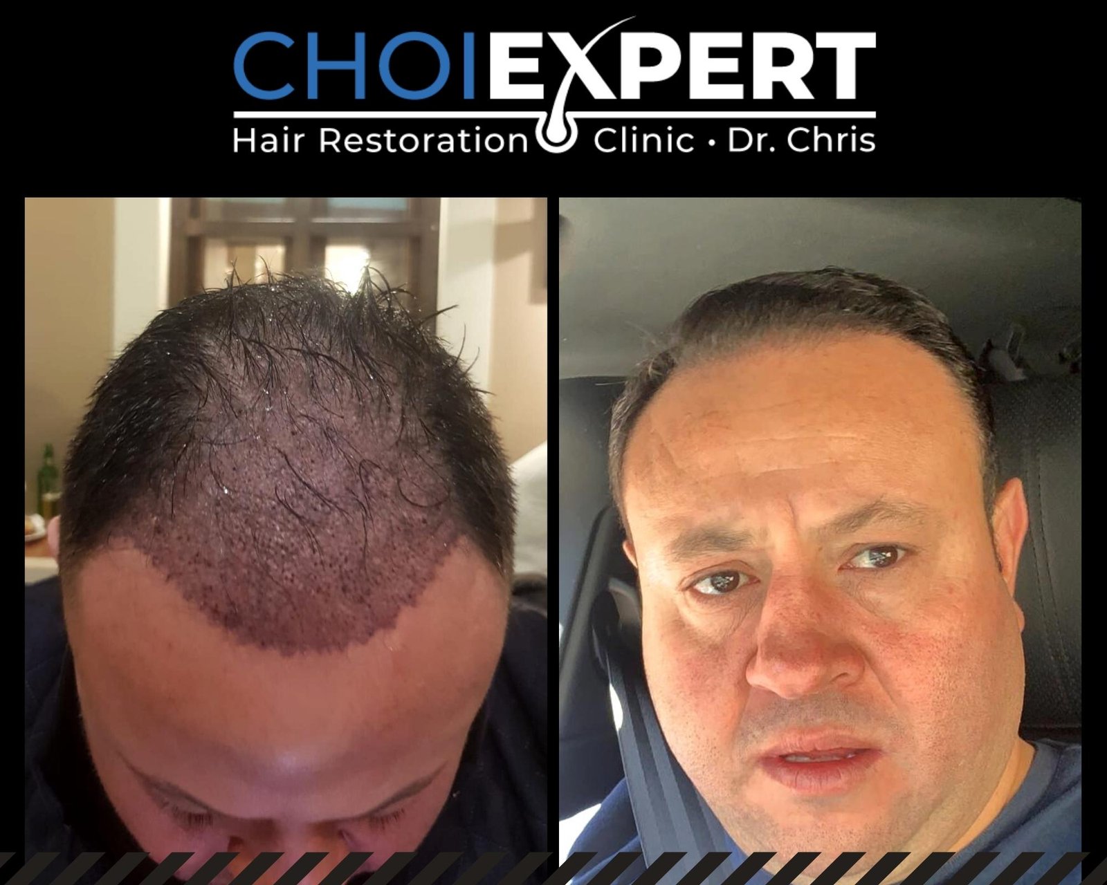 , VORHER NACHHER ERGEBNISSE