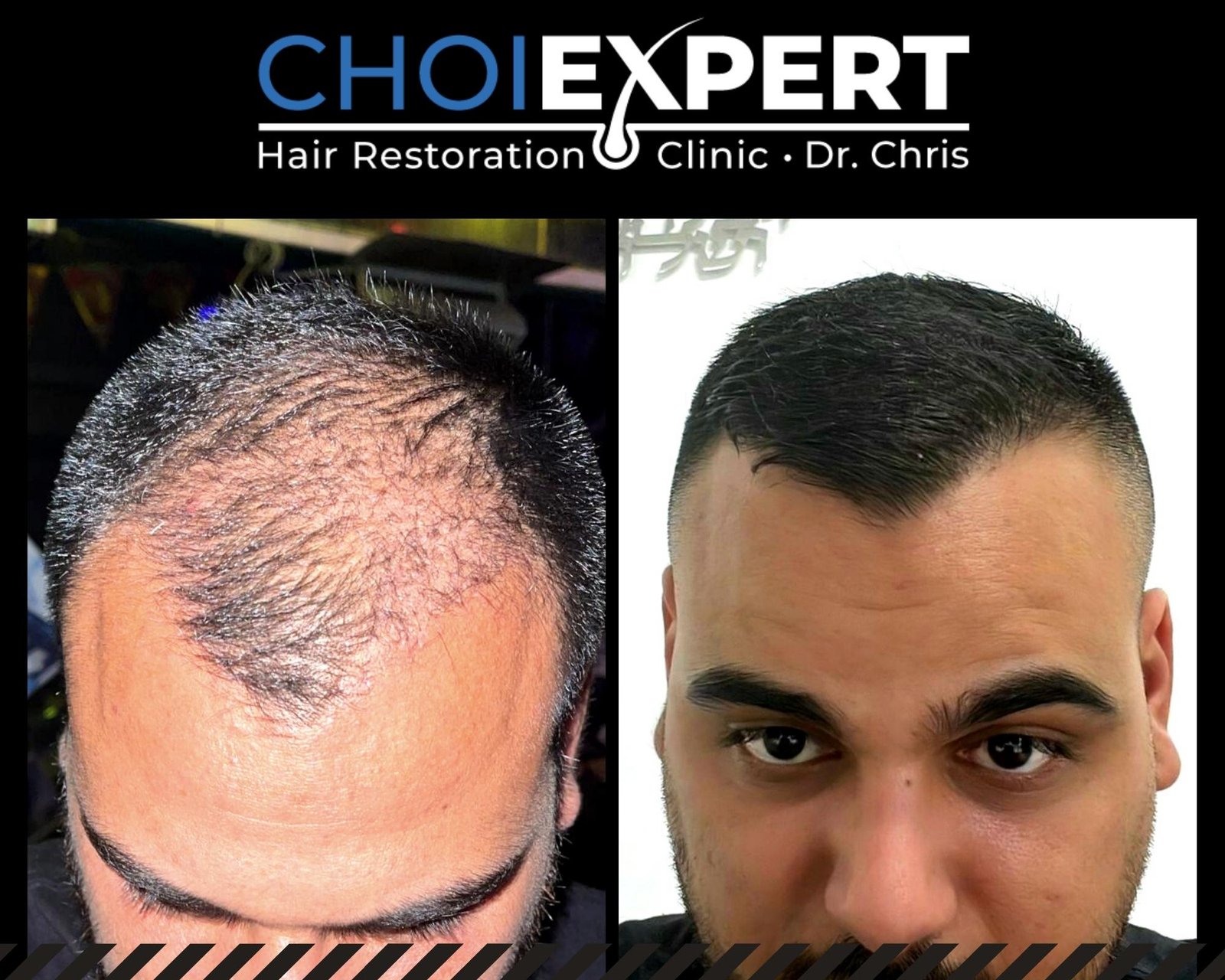 , VORHER NACHHER ERGEBNISSE