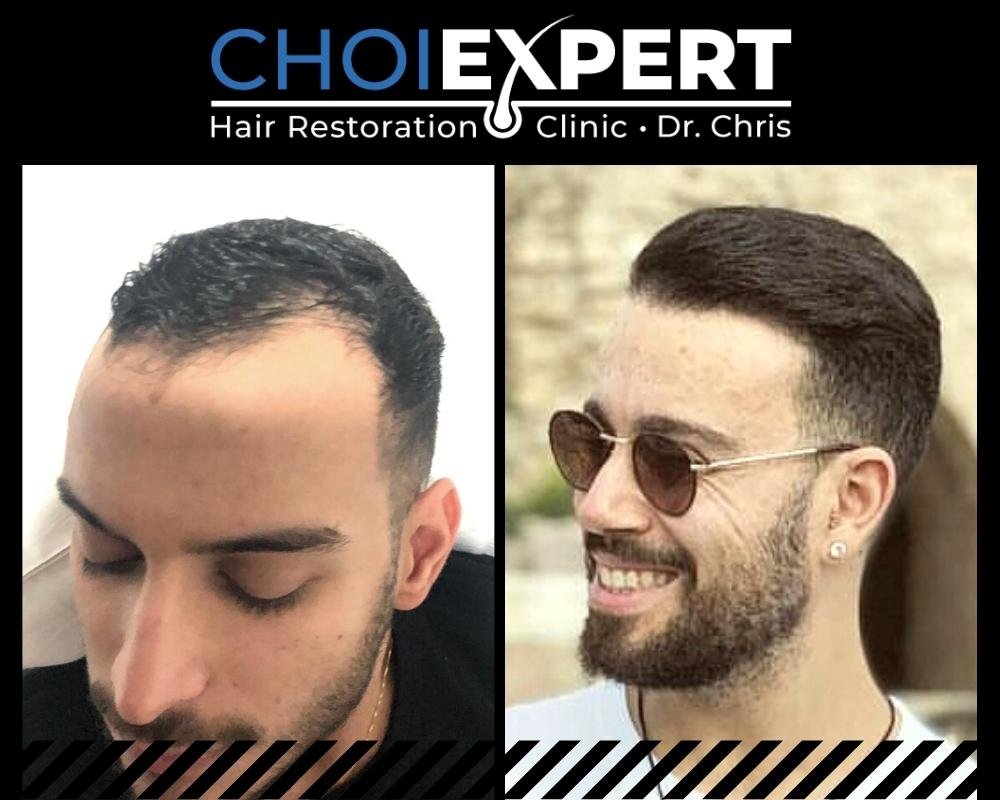 , VORHER NACHHER ERGEBNISSE