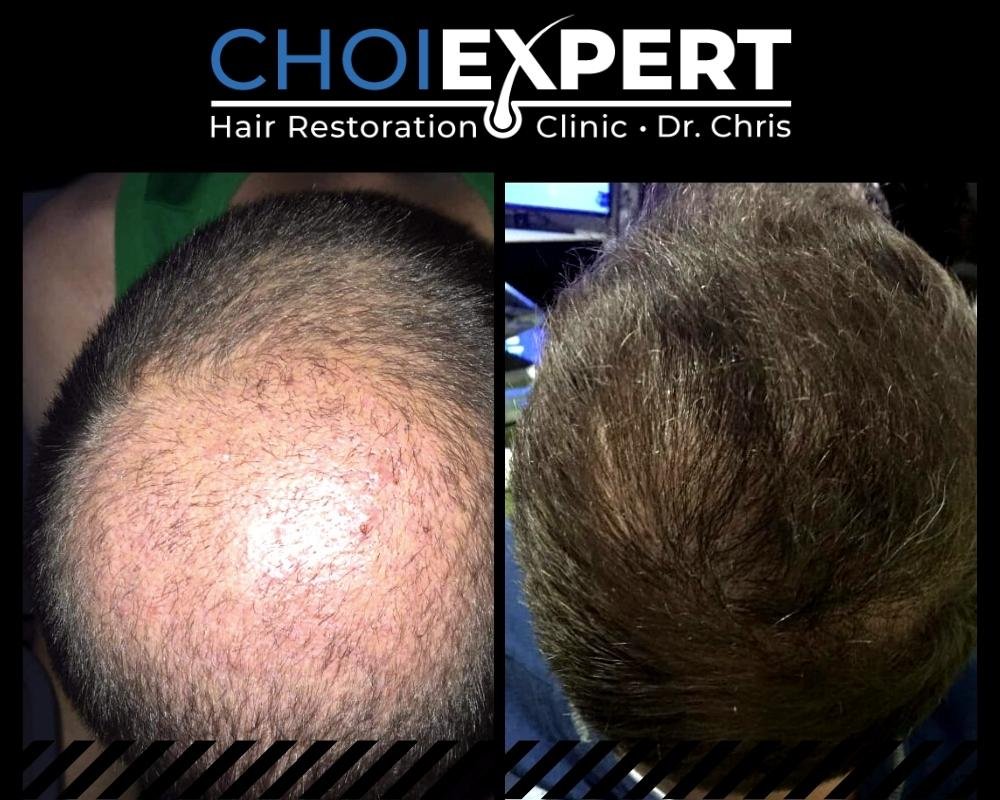 , VORHER NACHHER ERGEBNISSE