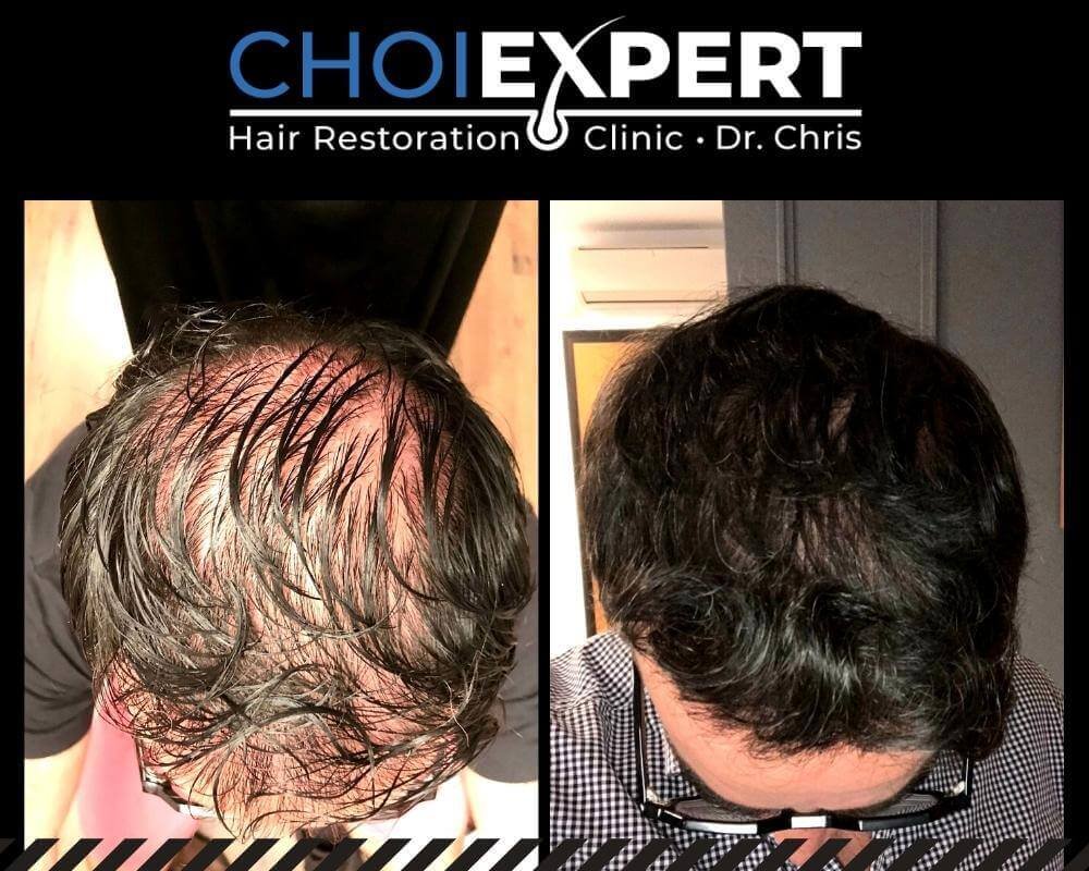 , VORHER NACHHER ERGEBNISSE