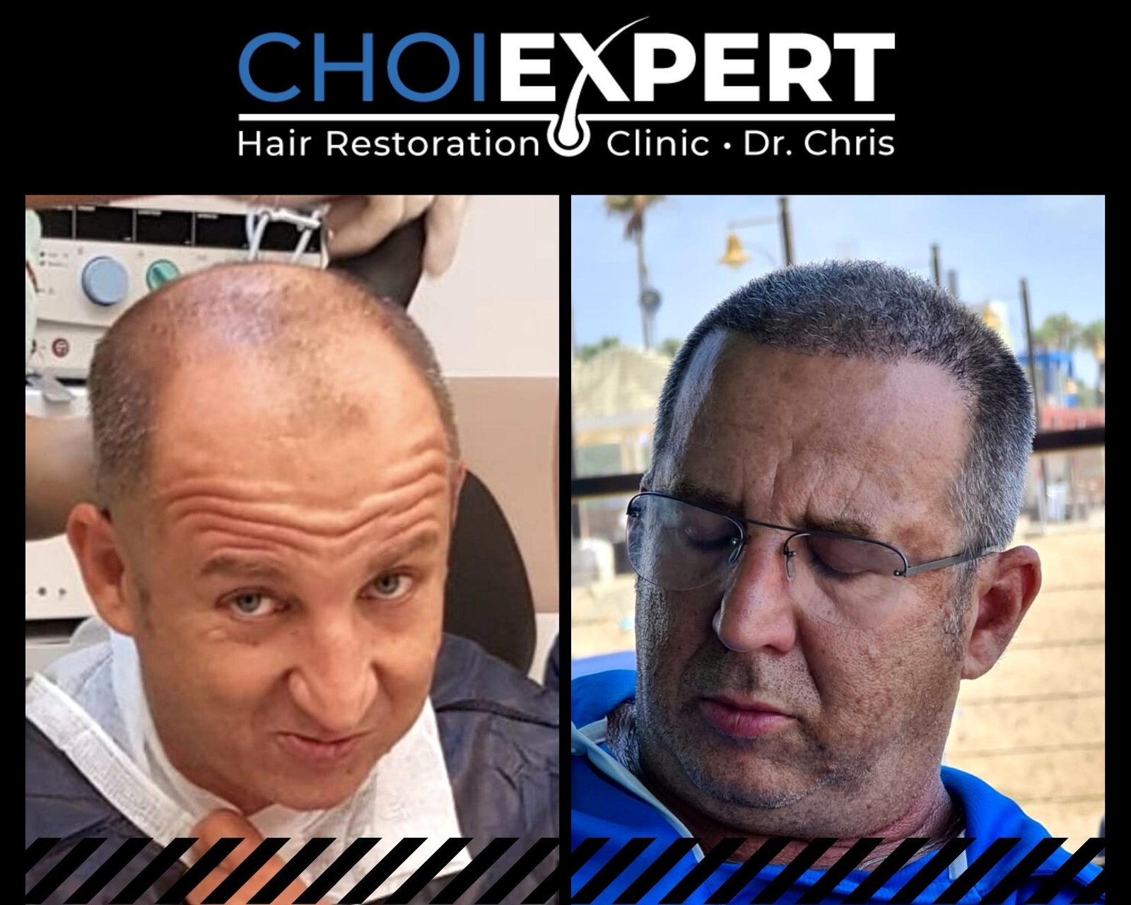 , VORHER NACHHER ERGEBNISSE