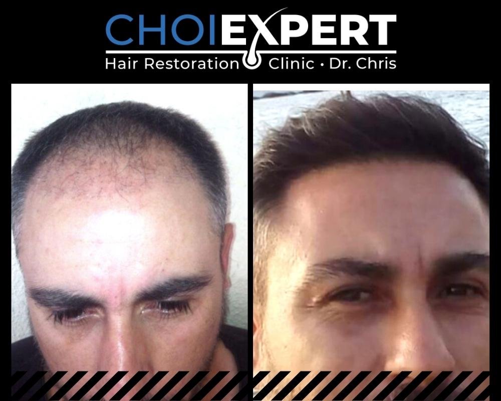 , VORHER NACHHER ERGEBNISSE