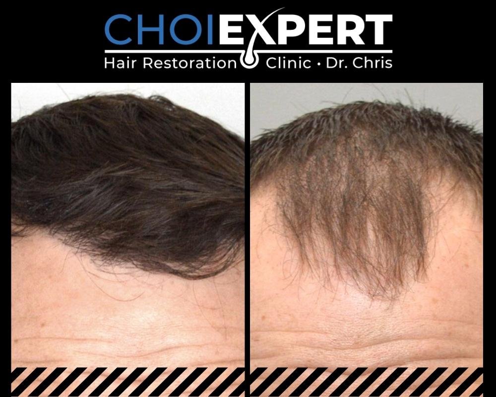 , VORHER NACHHER ERGEBNISSE