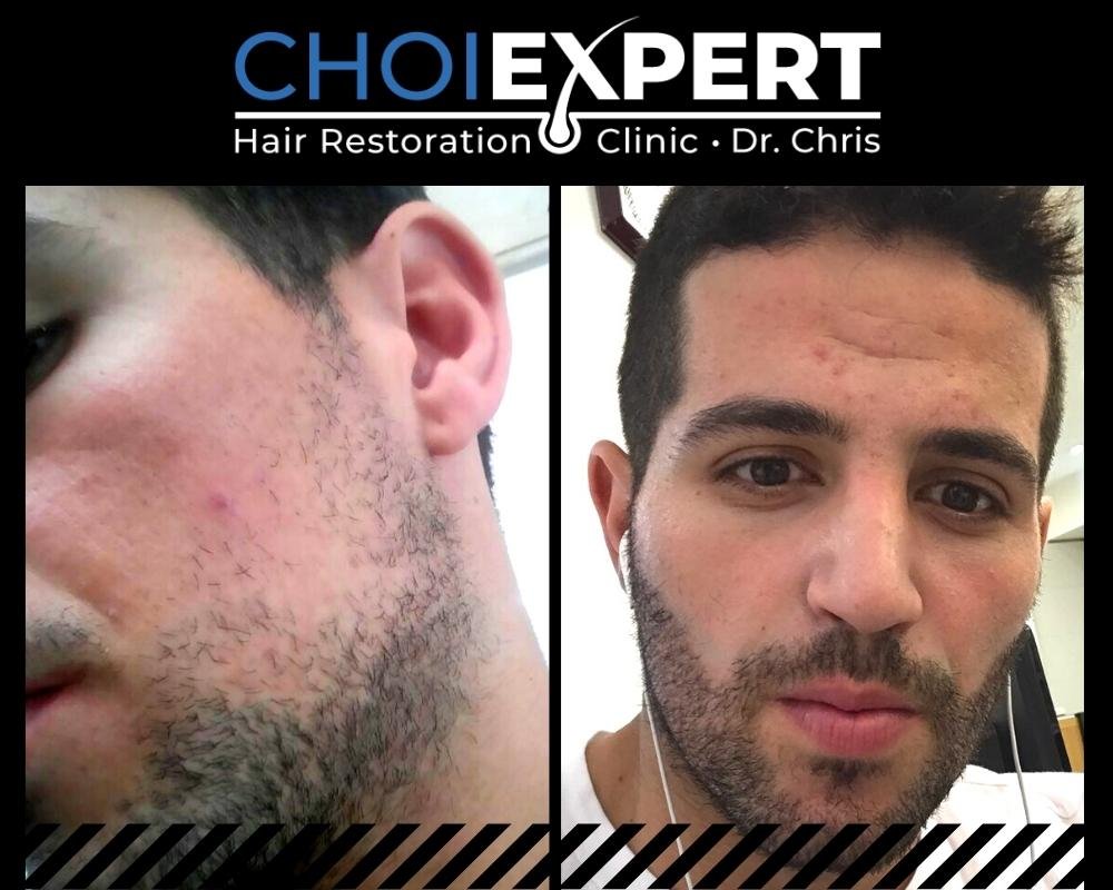 , VORHER NACHHER ERGEBNISSE