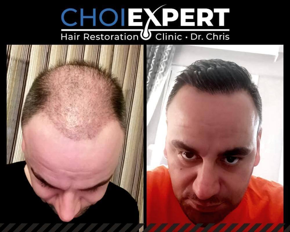 , VORHER NACHHER ERGEBNISSE