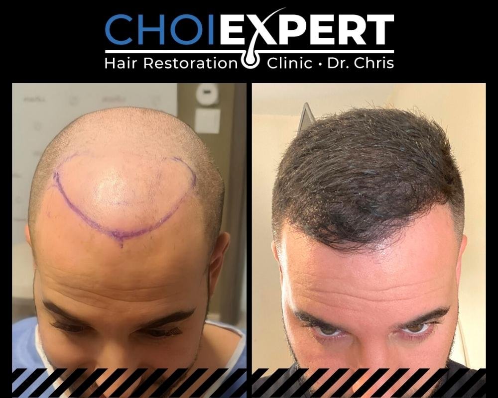 , VORHER NACHHER ERGEBNISSE