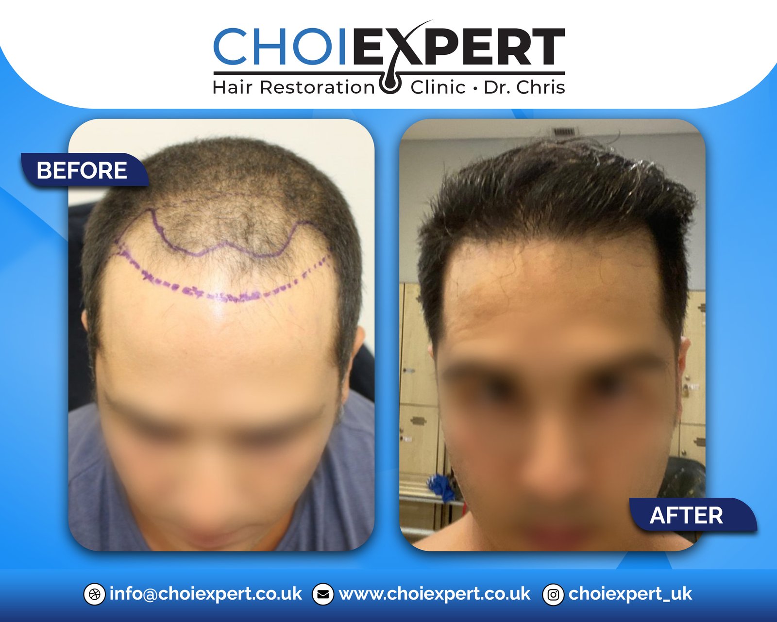 , Before & After Results